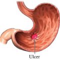 குடல் புண் (Ulcer)